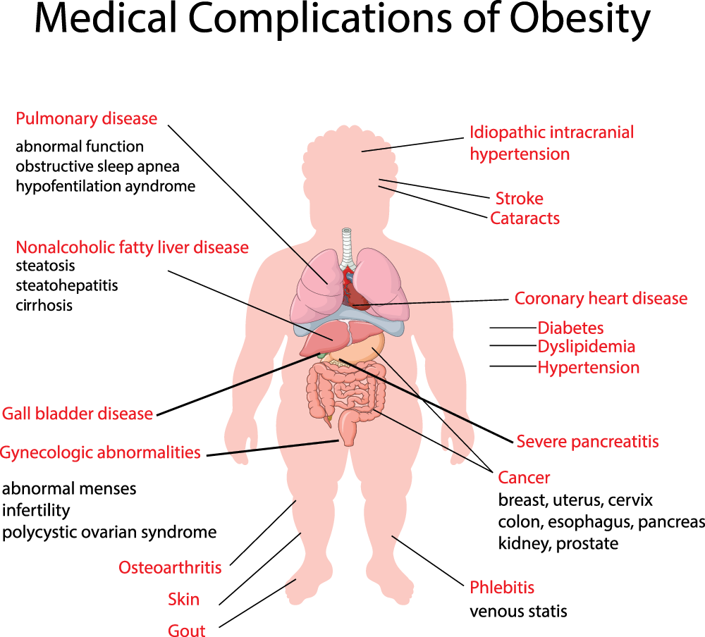 Medical Complications Obesity - Medical Obesity Complication (1000x904), Png Download
