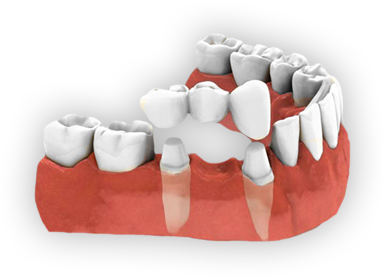 Crowns And Bridges - Dental Bridge Png (471x336), Png Download