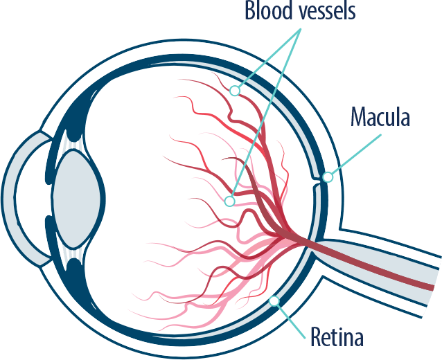 Eye Blood Vessels, Macula, And Retina - Retinal Vein Occlusion Cartoon (638x520), Png Download