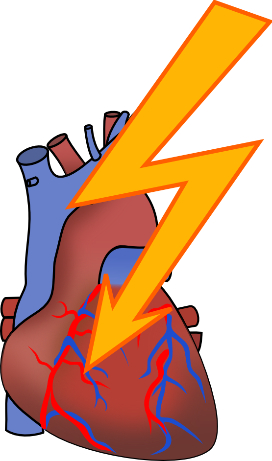 Heart - Heart Attack Clipart Png (555x942), Png Download
