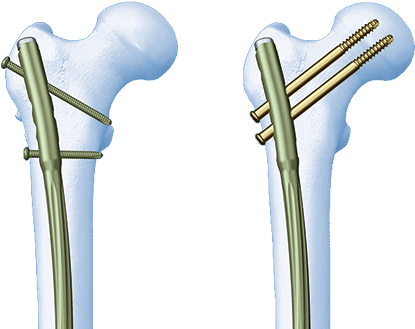 Choose - Lateral Femoral Nail (522x336), Png Download