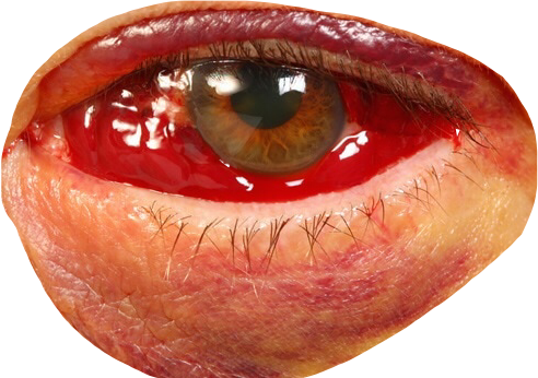 Report Abuse - Bloody Eye (492x346), Png Download