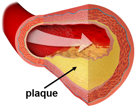 As A Conscientious Medical Practitioner, Dr - Damaged And Narrowed Arteries (450x365), Png Download
