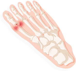 Big Toe, Making Bending Or Straightening Difficult - Illustration (370x343), Png Download