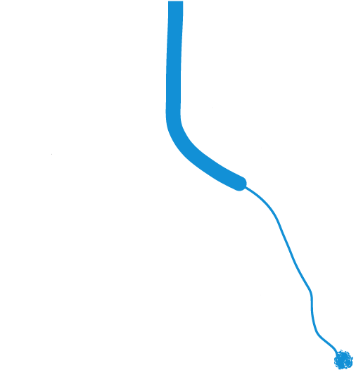 Bronchoscopy - Electromagnetic Navigation Bronchoscopy Biopsy (545x553), Png Download