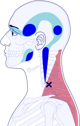 Classic “question Mark” Pain Brought About Through - Myofascial Trigger Point (292x448), Png Download