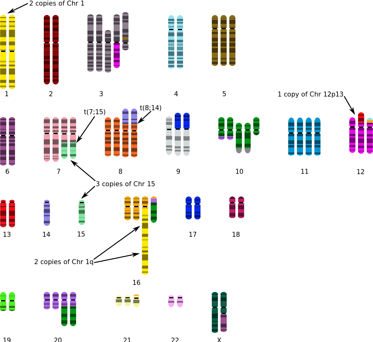 Breast Cancer Cell Karyotype (1200x1102), Png Download