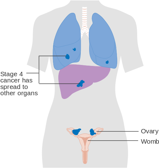 Diagram Showing Stage 4 Ovarian Cancer Cruk - Ovaries And Liver (556x600), Png Download