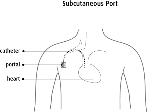 The Nurse Inserts A Special Type Of Needle Through - Subcutaneous Port Catheter (488x371), Png Download