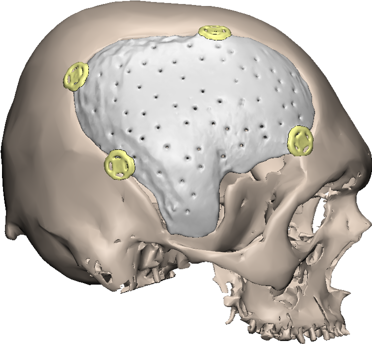 Side-pmma - Cranial Prosthesis Pmma (804x732), Png Download