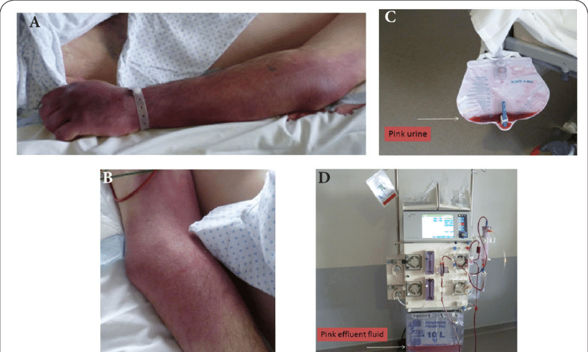 Pink Colored Skin Of The Left Forearm , Where Hydrocobalamin - Heel (850x509), Png Download