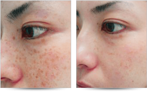 Ocean State Laser & Aesthetics, Brown Spot Removal - Apple Cider Vinegar Sunspots Before And After (600x350), Png Download
