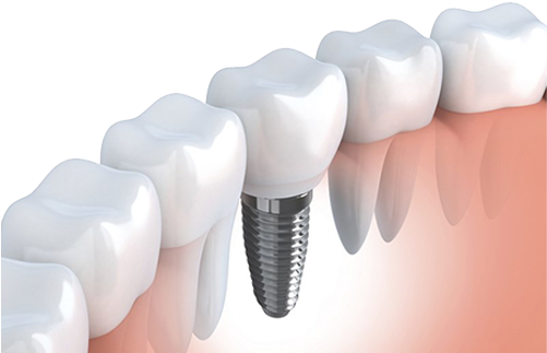 Dental Implants 1 - Implante De Muelas (500x332), Png Download