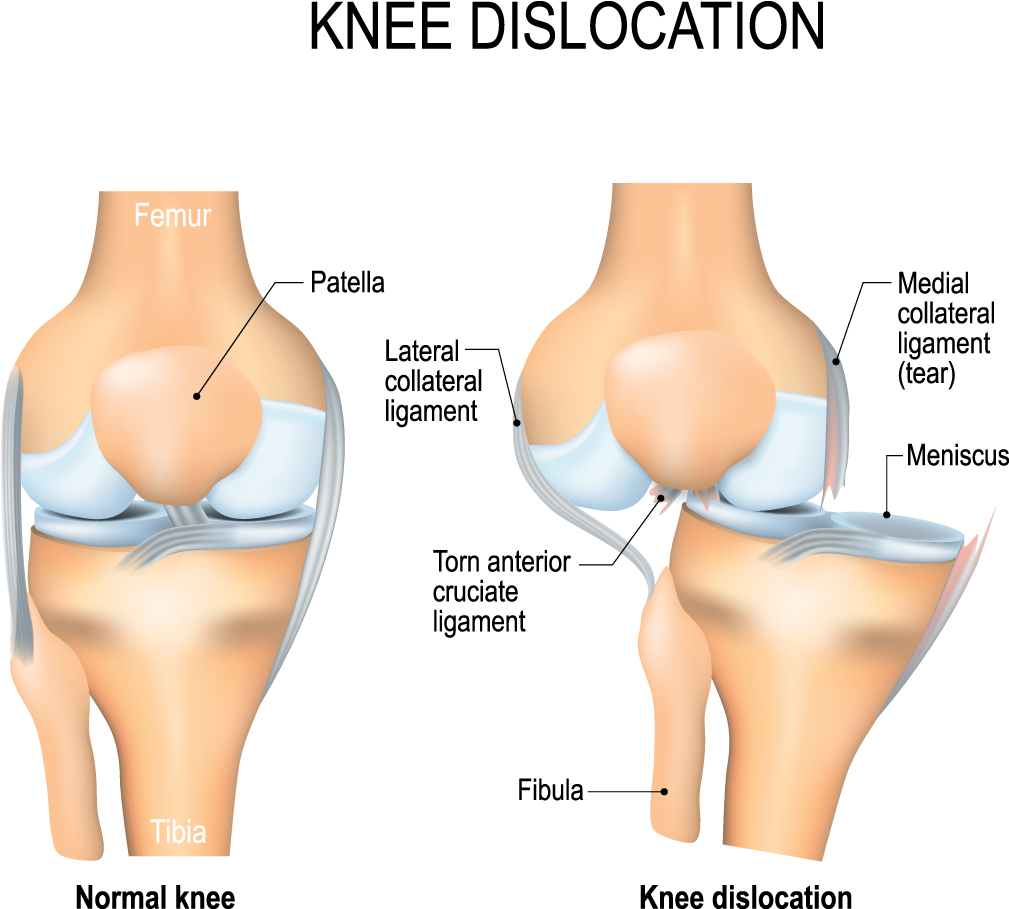 Acl Injury Physiotherapy Treatment - Knee Dislocation (1017x1017), Png Download