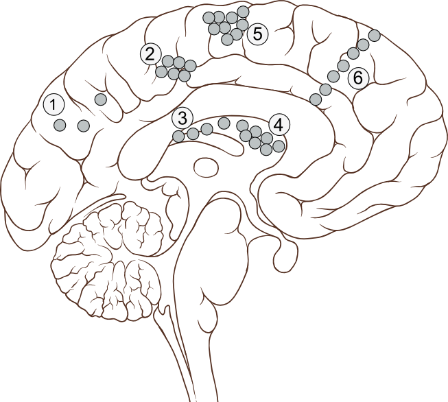 Tsc - Parietal Lobe (653x586), Png Download