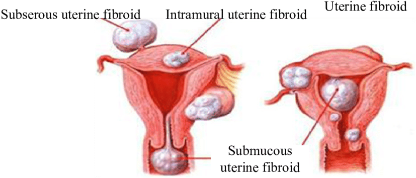 Types Of The Patients' Uterine Fibroids Table - Fibroid Uterus Types (850x381), Png Download