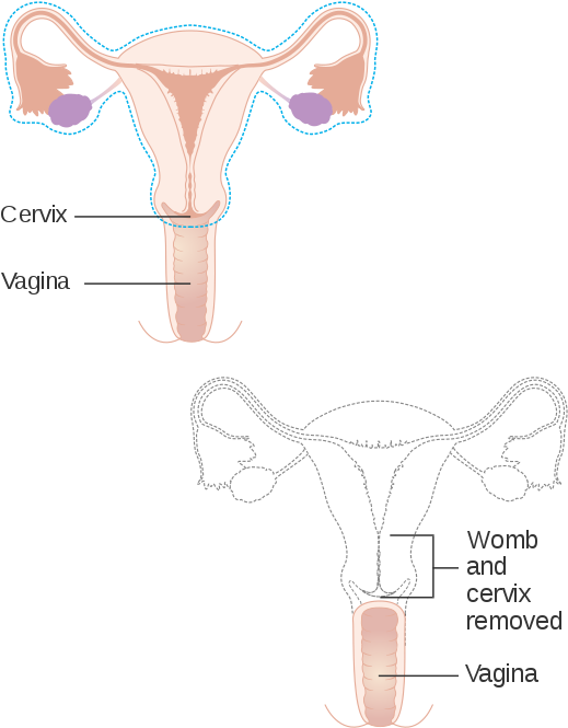 Hysterectomy (560x709), Png Download