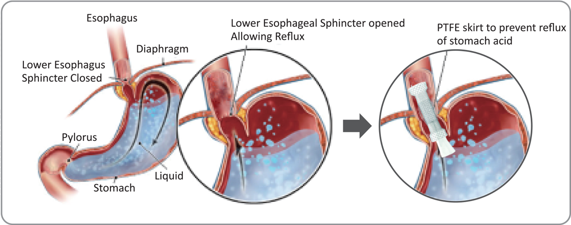 B - Anti Reflux Esophageal Stent (1280x720), Png Download