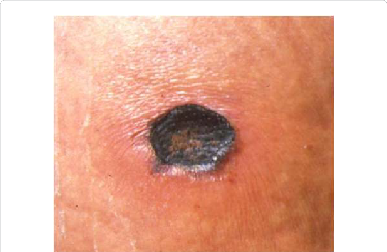 Mediterranean Spotted Fever Tache Noir (761x495), Png Download