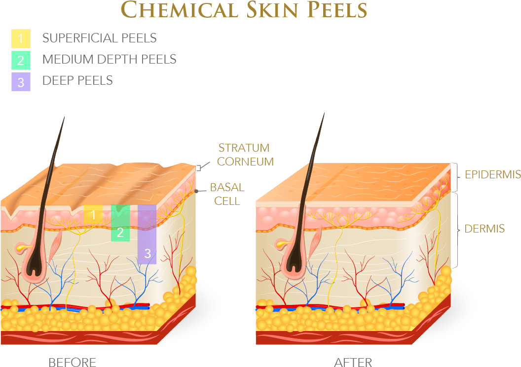Chemical Peels Come In Different Strengths, And The - Oily & Dry Skin (1191x842), Png Download