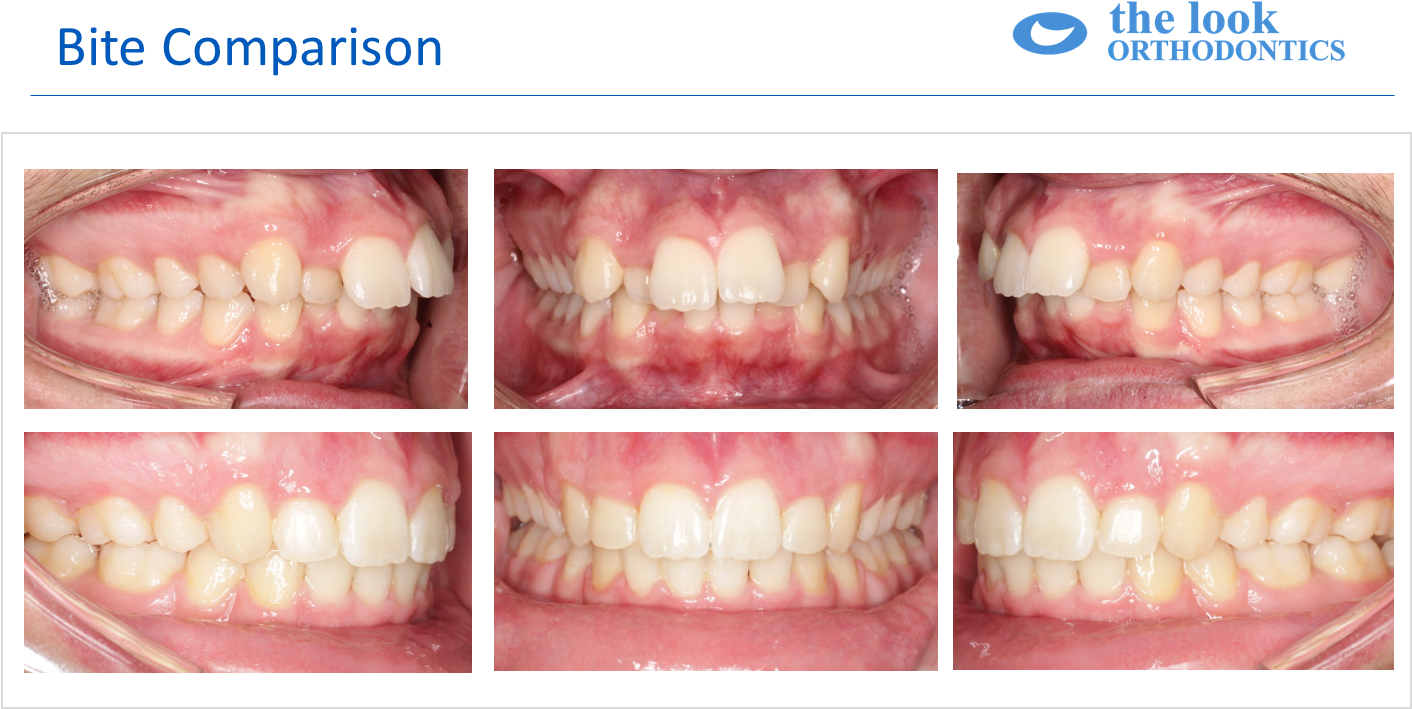 Svg Black And White Download Patient M R Crooked Protruding (1411x716), Png Download