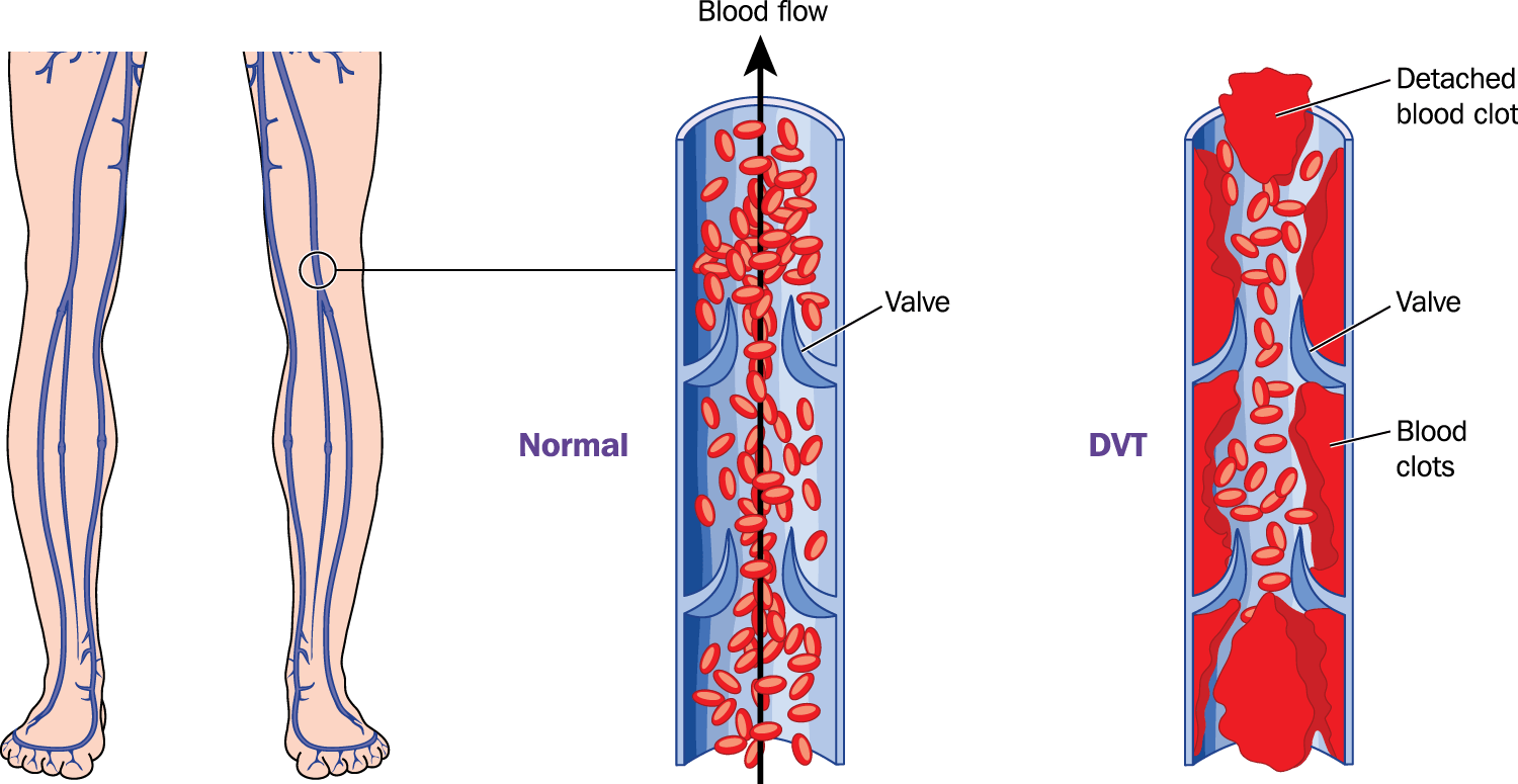 What Is Deep Vein Thrombosis - Dvt Pulmonary Embolism (1500x775), Png Download