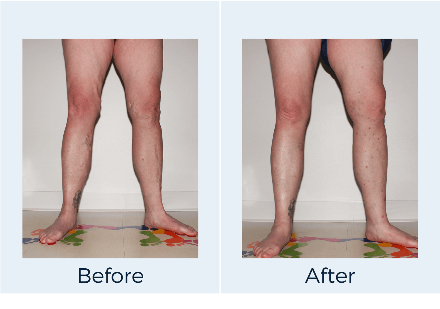 Varicose Vein Treatment And Spider Vein Treatments - Varicose Veins Ablation Radiofrequency (1500x1075), Png Download