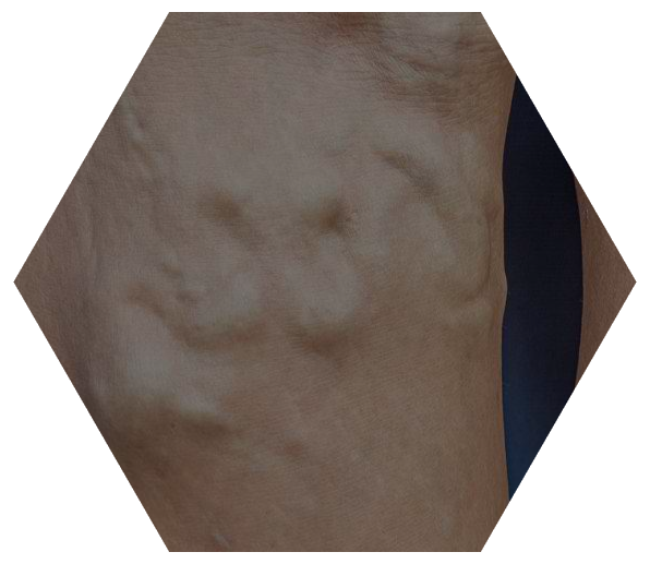 Varicose Veins (596x517), Png Download