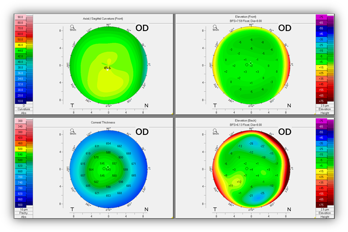4 Maps Refactive Of The Stable Right Eye (725x487), Png Download