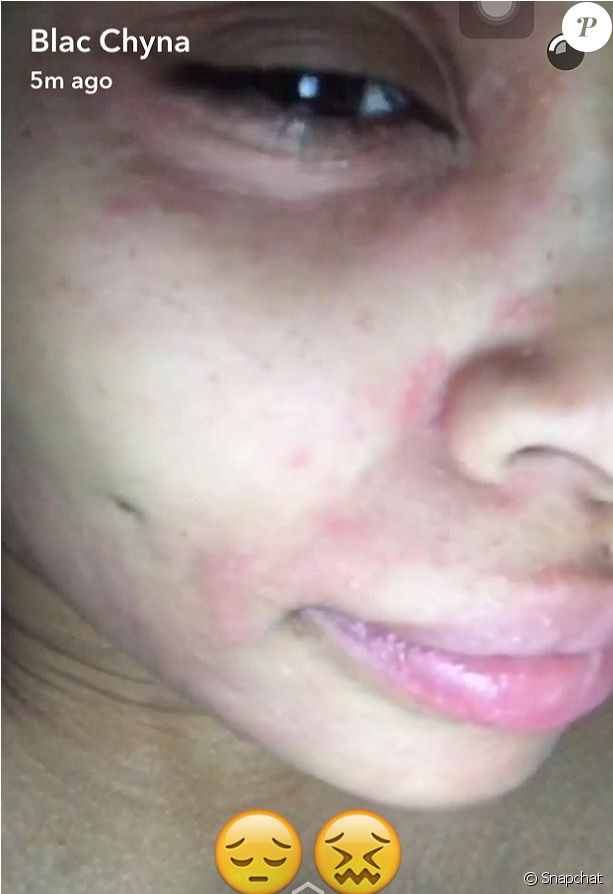 Blac Chyna A Fait Une Réaction Allergique À Un Soin (950x893), Png Download