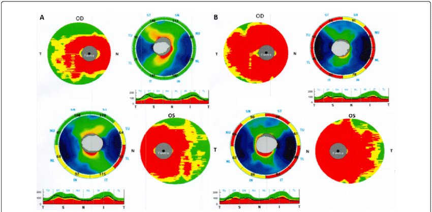 Optic Coherence Tomography (850x417), Png Download