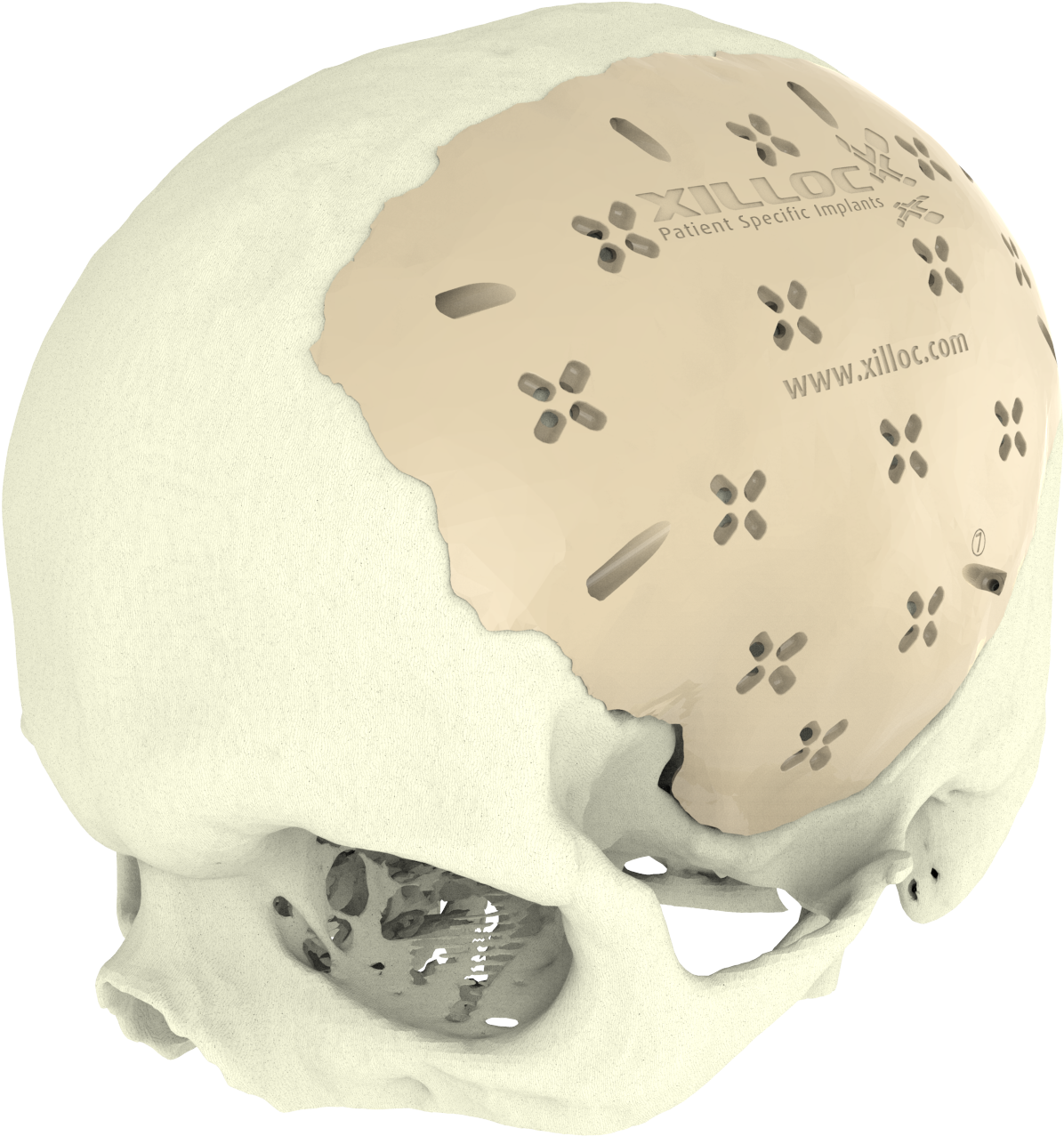Cranial-implant - Implant (1920x1424), Png Download