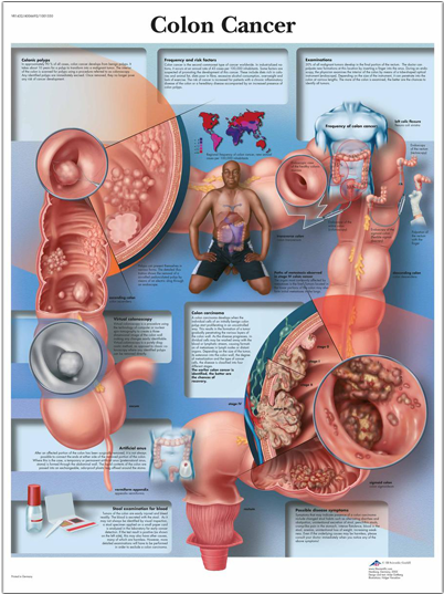 Anatomical Chart - Colon Cancer - Colon Cancer Anatomy (720x540), Png Download