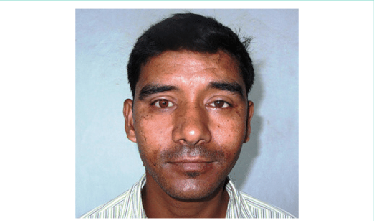 Insertion Of Ocular Prosthesis - Human (744x440), Png Download