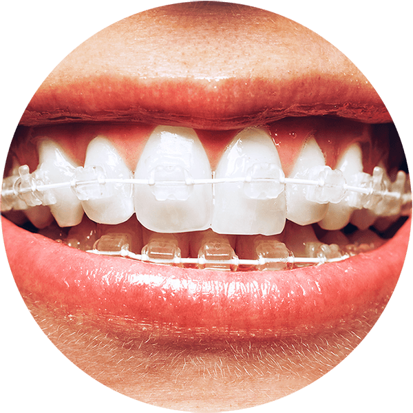 How Do Braces Work - 6 Month Smile Braces (600x600), Png Download