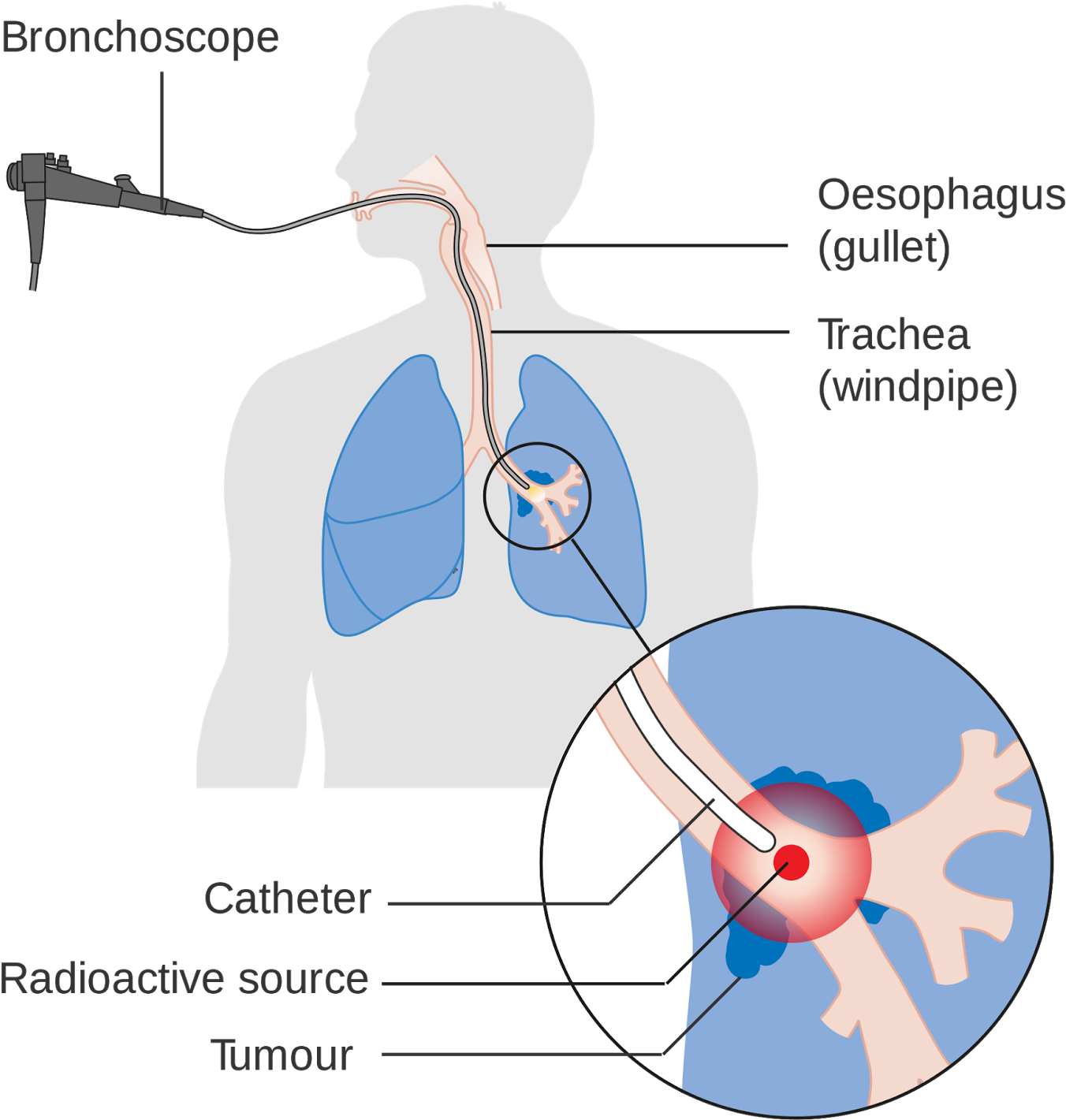Lung Cancer Is The Leading Cause Of Death Due To Cancer - Lung Cancer Radiation Therapy Diagram (1463x1600), Png Download