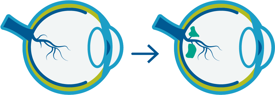 Over Time, Diabetes Can Damage Blood Vessels Causing - Circle (960x720), Png Download