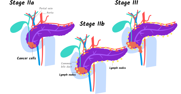 Illustration Of Stage Iia, Iib, And Stage Iii Pancreatic - 4 Pancreatic Cancer Stages That Help You (768x400), Png Download