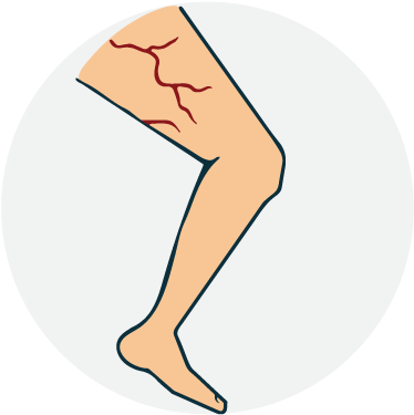 Varicose Vein - Illustration (842x595), Png Download