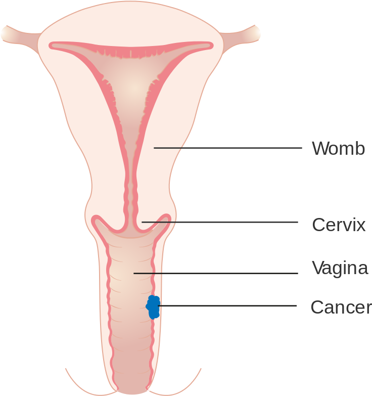 Open - سرطان المهبل (1000x896), Png Download