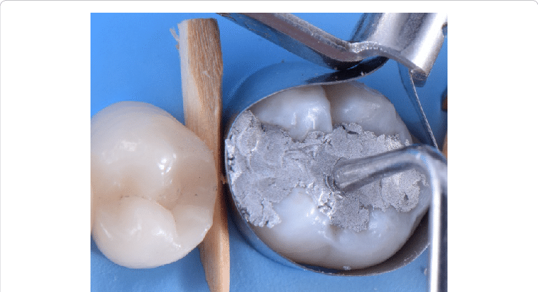 Manual Condensation Using Ward Condensers From 1 To - Manual Condensation Of Amalgam (761x414), Png Download