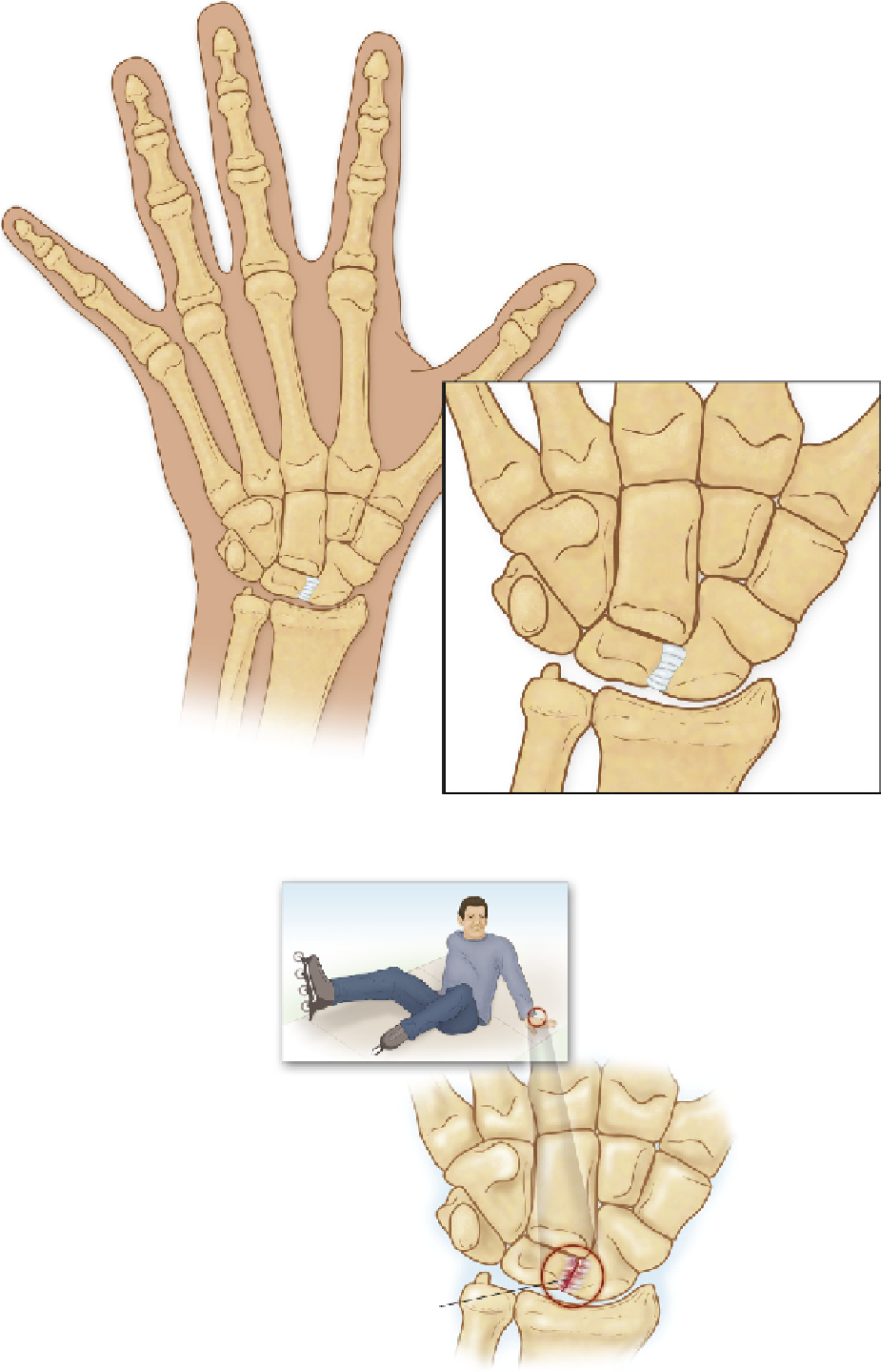 Scapholunate Ligament Tear Syndrome - Scapholunate Ligament Tear Symptoms (926x1448), Png Download