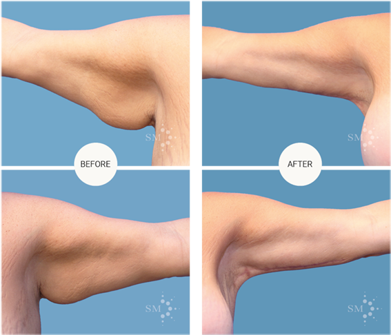 Brachioplasty - Brachioplastie (600x600), Png Download