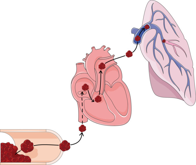Pulmonary Embolism (680x574), Png Download