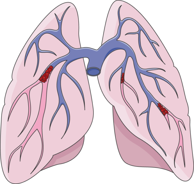 680 X 645 1 - Pulmonary Embolism Clip Art (680x645), Png Download