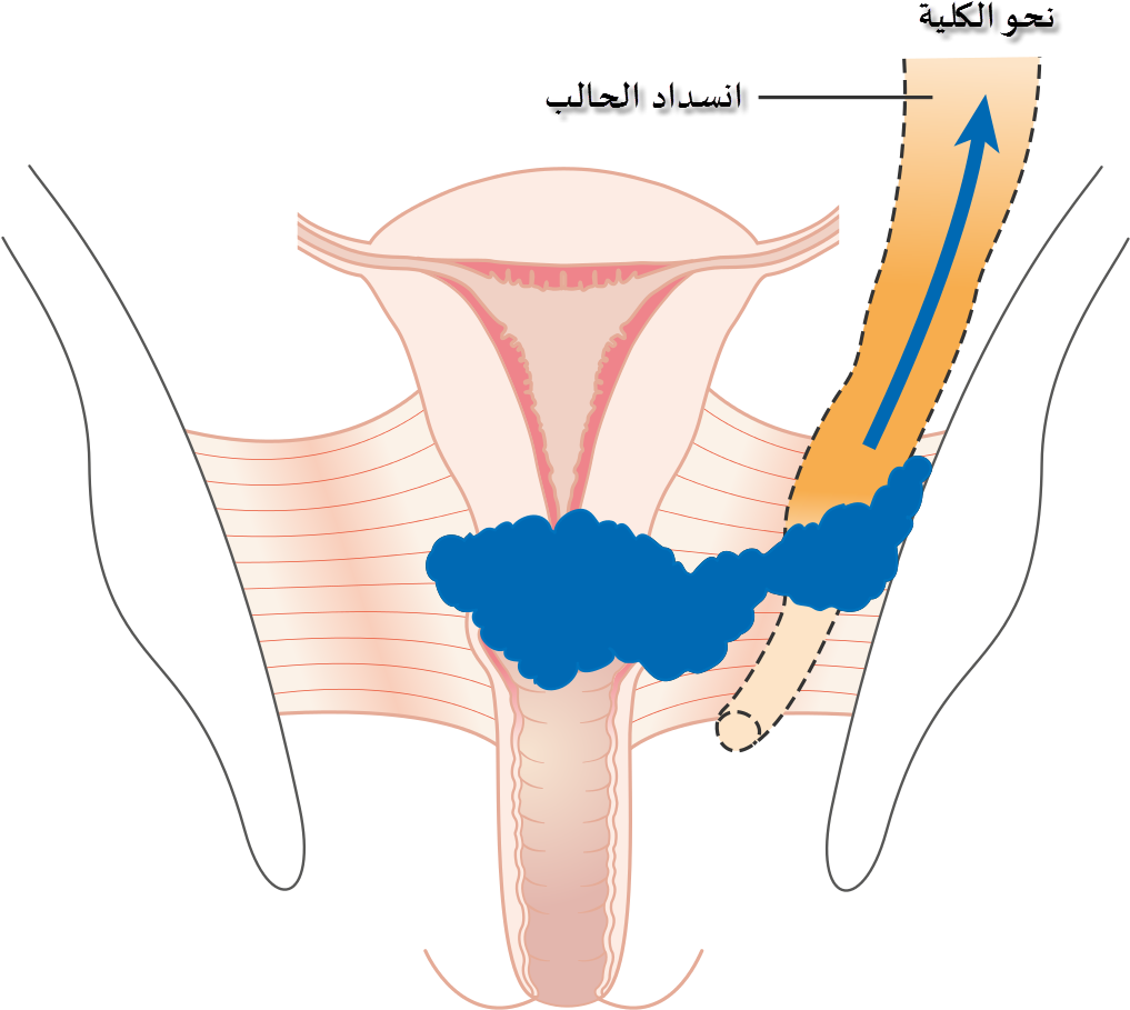 Diagram Showing Stage 3b Cervical Cancer Cruk 226-ar - Stage 3 Cervical Cancer (1200x1024), Png Download