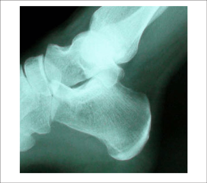 Radiograph Before Shock Wave Therapy - Radiography (711x629), Png Download