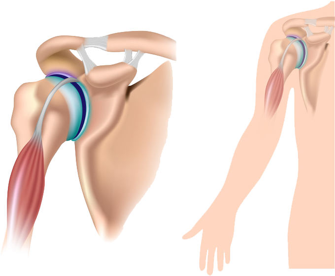 Non-surgical Options - Separated Shoulder (800x640), Png Download