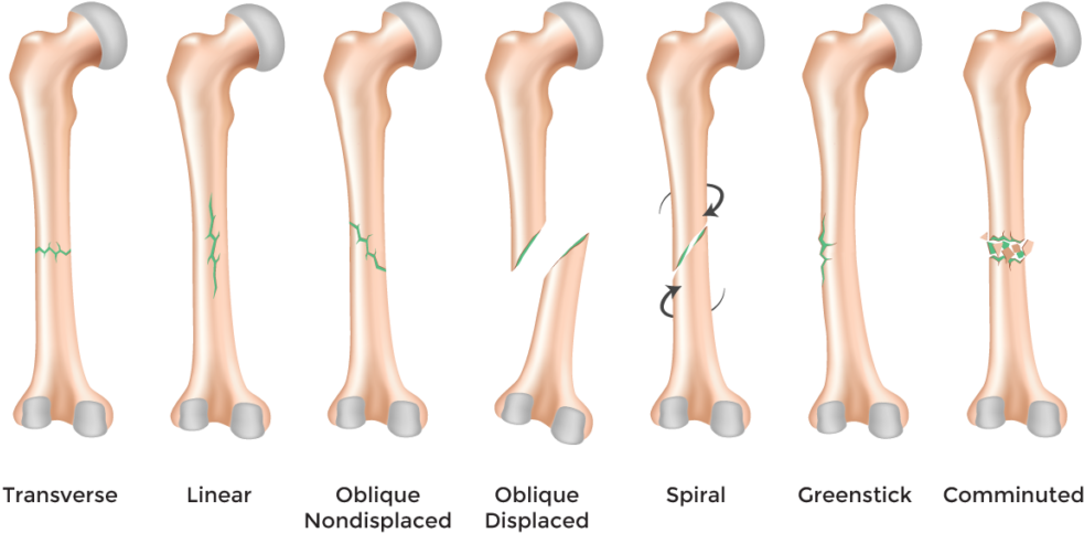 "bone Fracture" - Types Of Bone Fractures In Humans (1024x515), Png Download