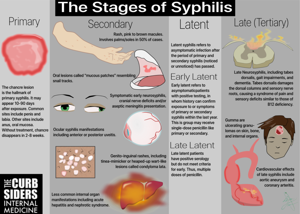 Infographic The Curbsiders 127 Stis Stages Of Syphilis - Syphilis Stages (1024x729), Png Download
